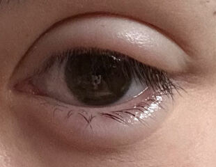 Corneal erosion is driving me insane.