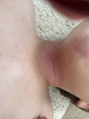 Eczema - should I use steroid cream now?