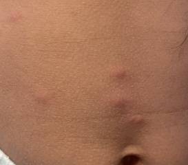 What is this rash?