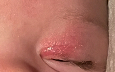 My little DDs swollen eyelid (do I need to worry)