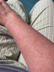 Fed up with keratosis pilaris