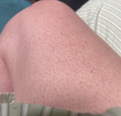 Fed up with keratosis pilaris