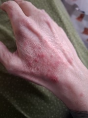Anyone got hashimotos disease? Just been diagnosed and have so many questions.