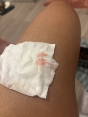Bleeding very early pregnancy