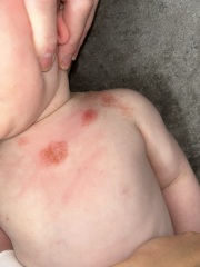 My baby’s eczema