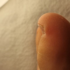 Ingrown toenail