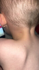 Another chicken pox one…