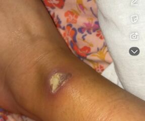 What kind of burn is this gross pic attatched