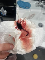 Bleeding and blood clotting 14 weeks pregnant