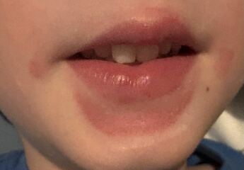 Rash around mouth of 4 year old