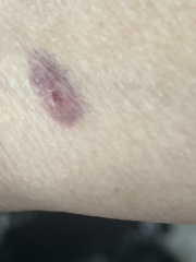 Is this a bite, scratch or something else?