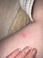 Bites or hives??