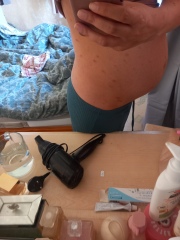 Help! What is this itchy pregnancy rash? (Pics)