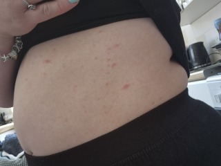 Rash all over breasts and torso