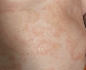 Rash! need help identifying