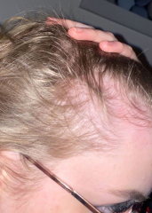 DD17 hair is really thinning and getting her down.