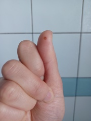 Wart or blood blister on thumb?