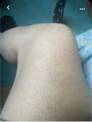 Fed up with keratosis pilaris