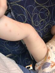 Weird rash on 2yr old toddler
