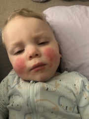 Rash on the face