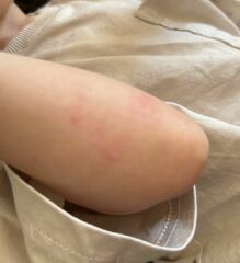 Rash on toddler ??