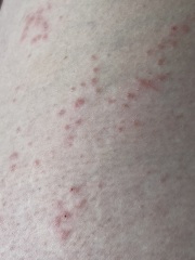 Anyone any good with rashes? What could this be?