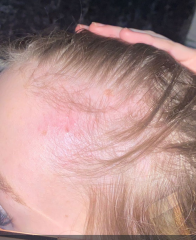 DD17 hair is really thinning and getting her down.