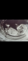 12 weeks 3 days - gender guess