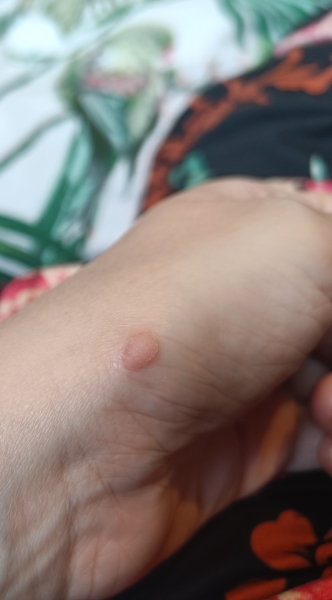 Is this a wart or should I see a doctor?