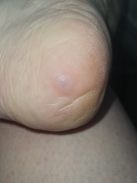 Is this what I think it is... anyone have experience with piezongenic papules