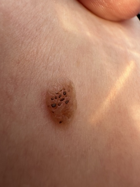 Help - Mole with dark spots - Image Included