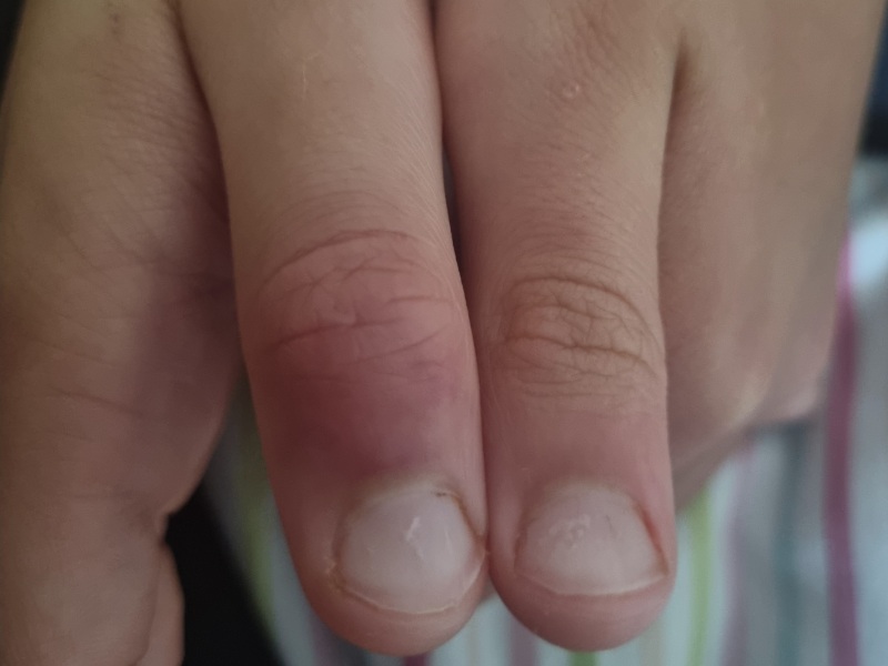 Thumb trapped in car door