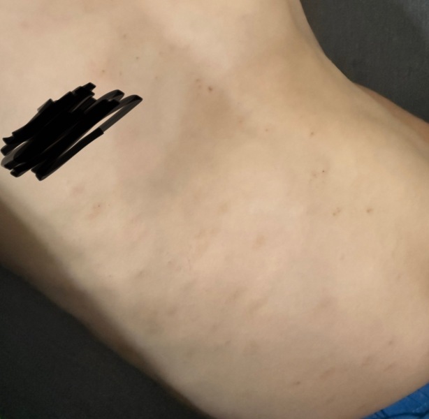 Chickenpox after 1 vaccine, any experiences?!