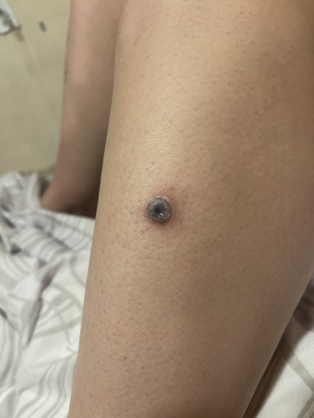 Does this look like skin cancer?