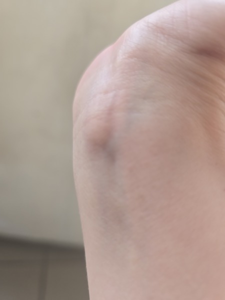 Lump in the inside inner part of wrist