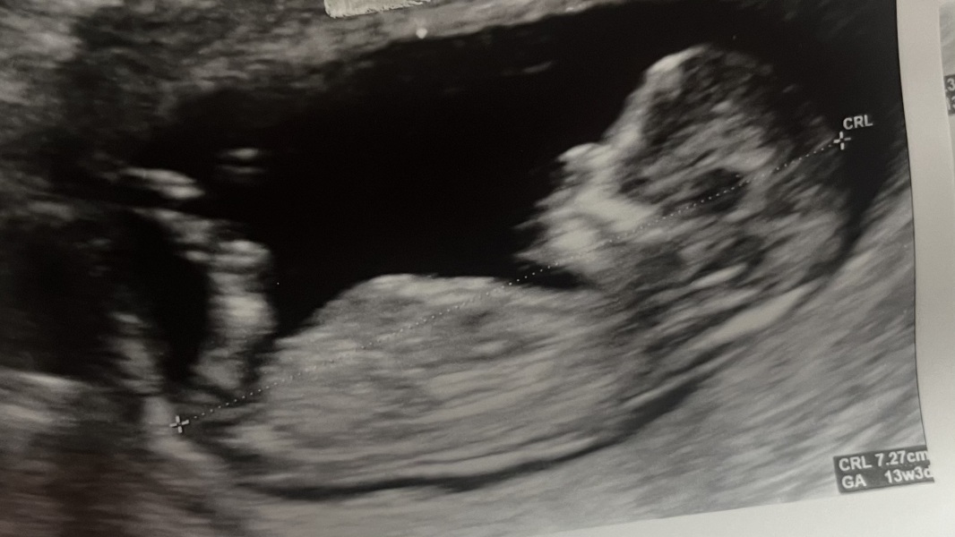 13 weeks scan tomorrow- need a bit of reassurance