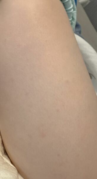 Is This Chicken Pox?