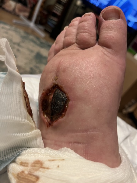 Healing? (apologies picture wound site hopefully inserted)