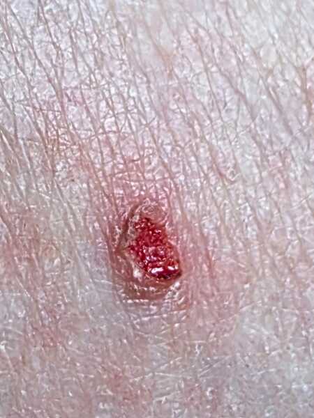 Crusty Rice Crispy on my leg - do I need to be checked? (Crusty Image Warning)