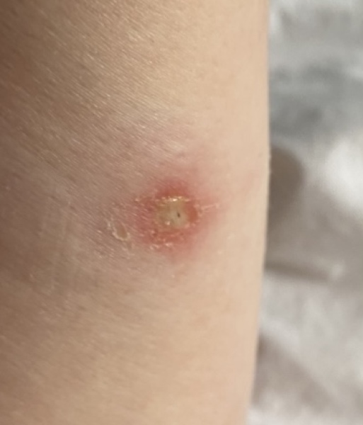 Scratch on arm