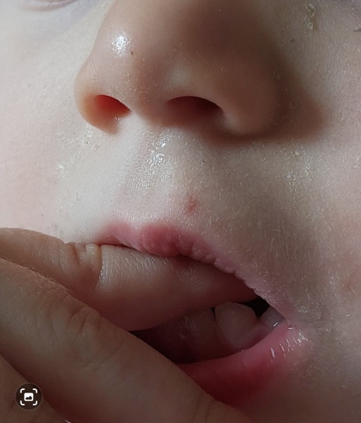 Is this a coldsore on my toddler?