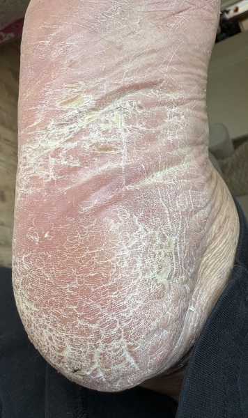 🤢 Very dry & flaky skin on foot - See Photo 🤮