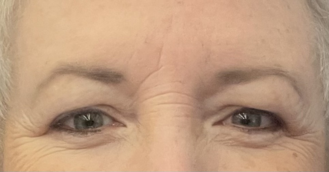 Is there any way to reduce my hooded eyes?