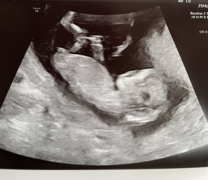 Nub theory, does it look like a boy or girl