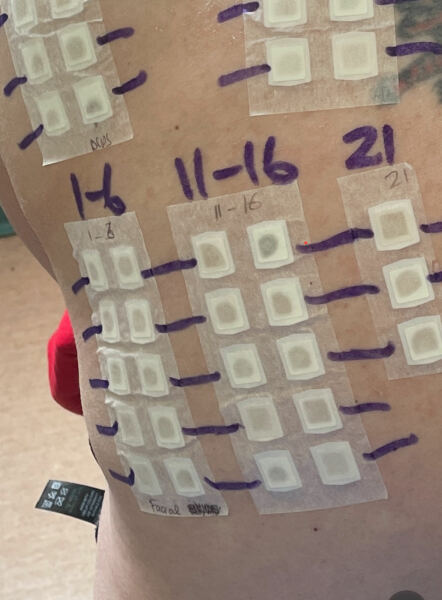 Had anybody had allergy test done on their back?