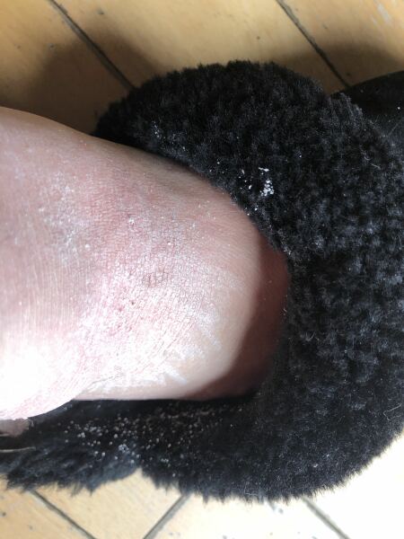 What the heck is wrong with my feet? (Warning: gross pic)