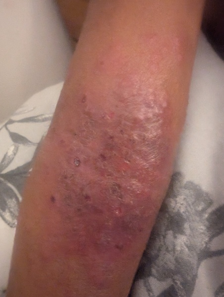 Eczema and chickenpox!