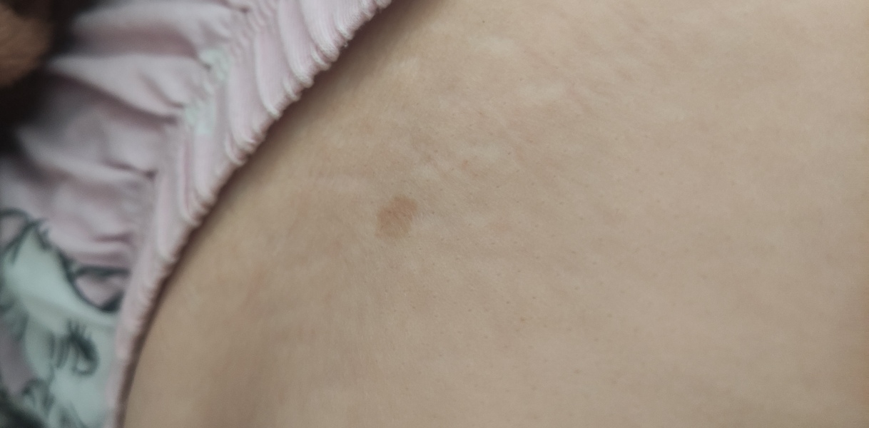 Worried about this mole