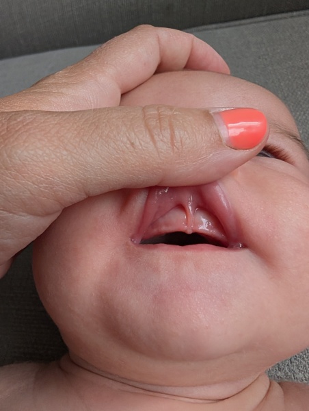 Is this a lip tie?