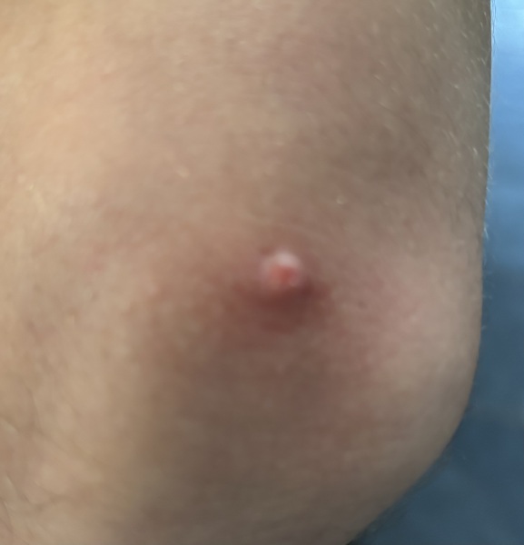 Elbow lump- any ideas?